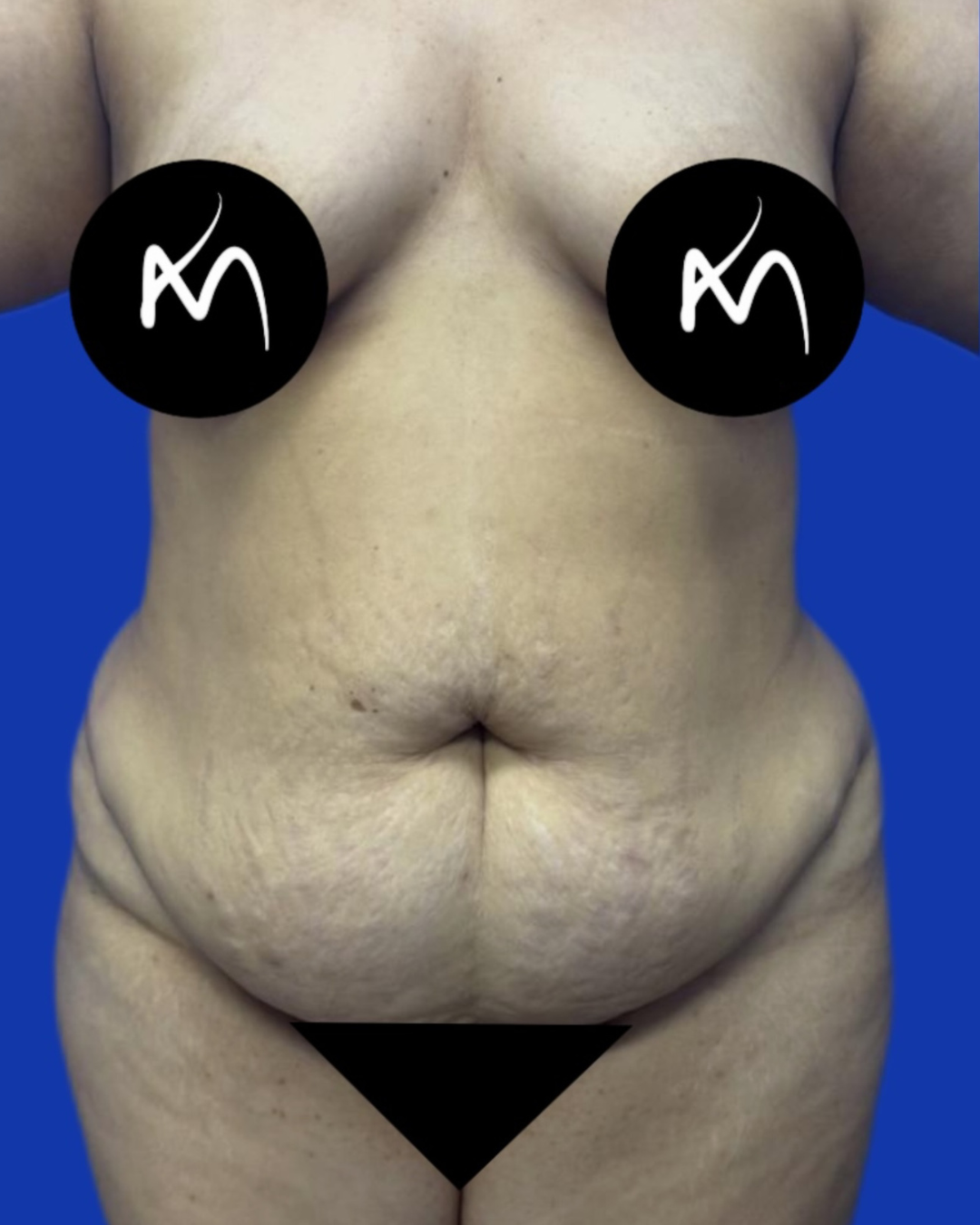 Antes de abdominoplastia — caso 1