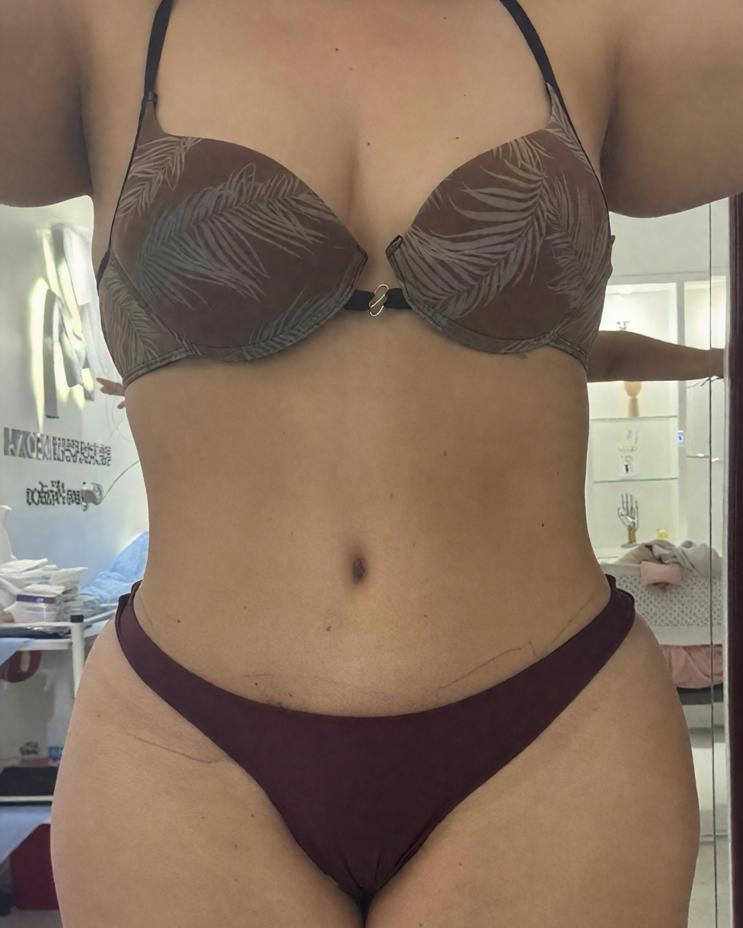 Después de abdominoplastia — caso 1